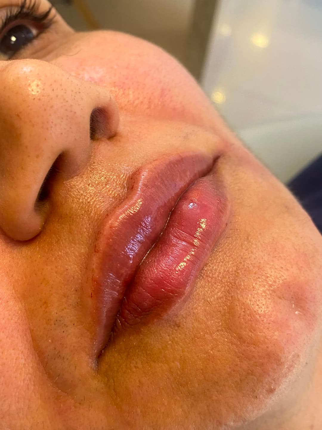 Resultado de preenchimento labial, detalhe do contorno