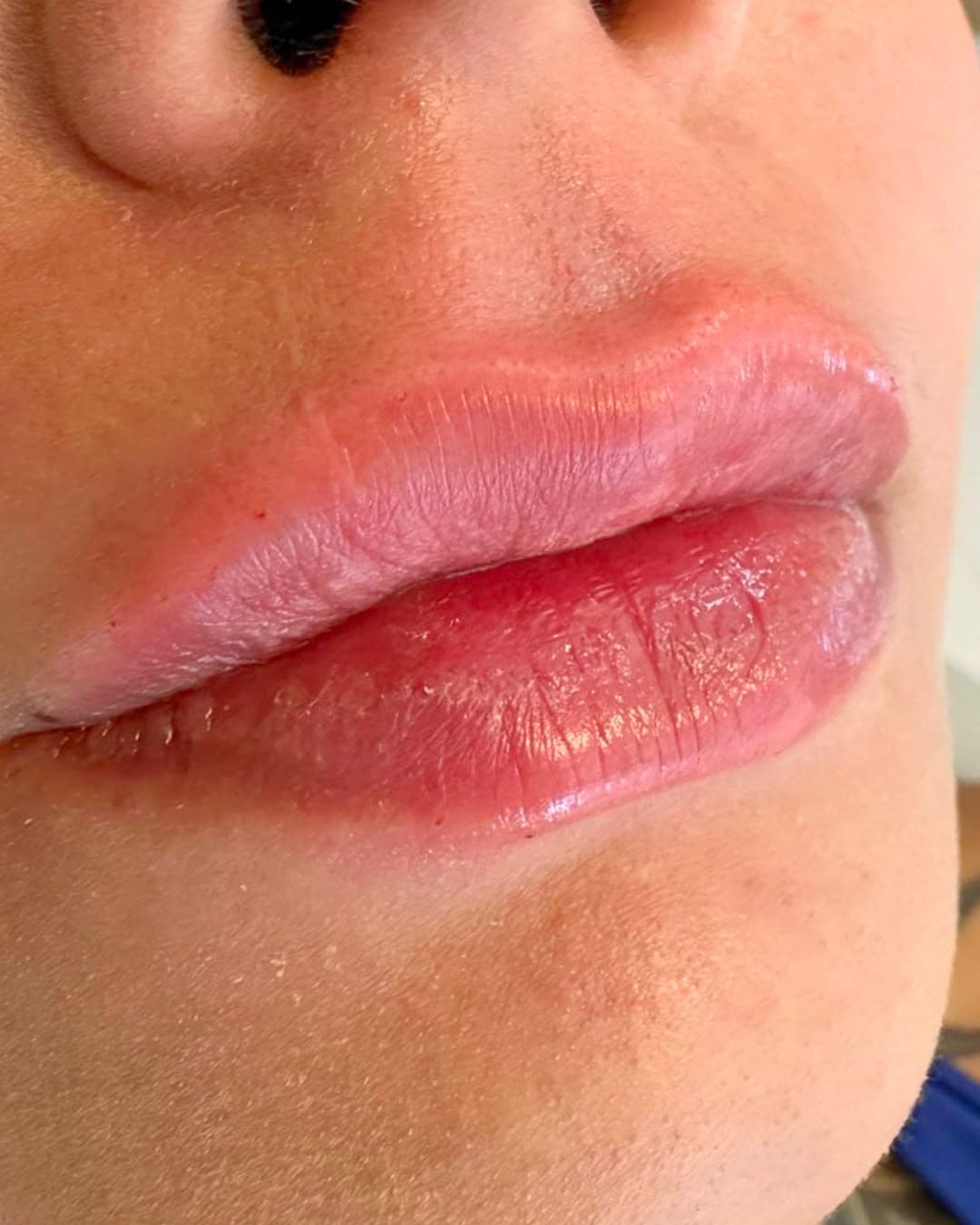 Resultado de preenchimento labial, volume natural